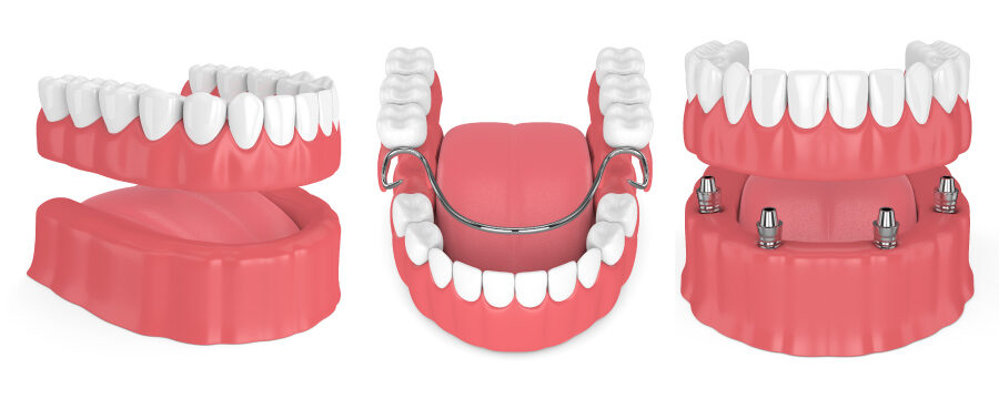 3 different types of dentures to restore your smile, full, partial & implant-supported