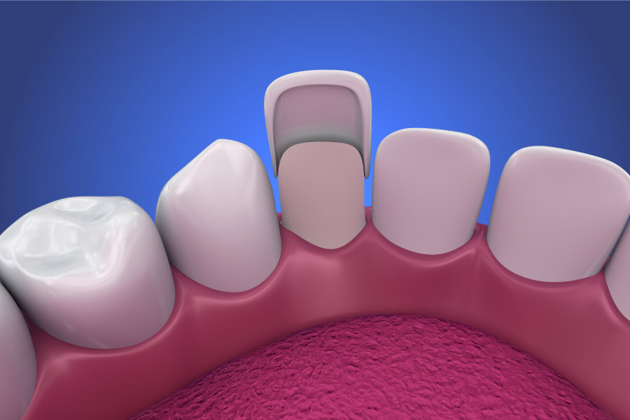 model of the porcelain veneer process