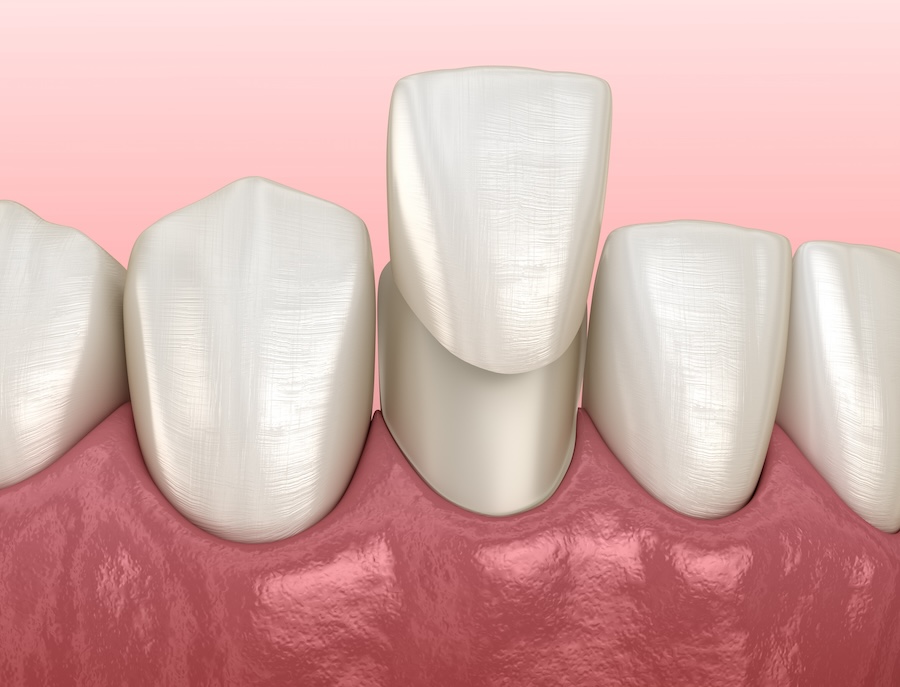 dental veneers, porcelain veneers, cosmetic dentistry, veneers care, Portland dentist