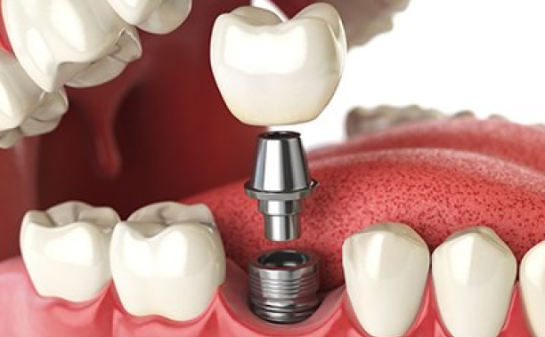 illustration for dental implant